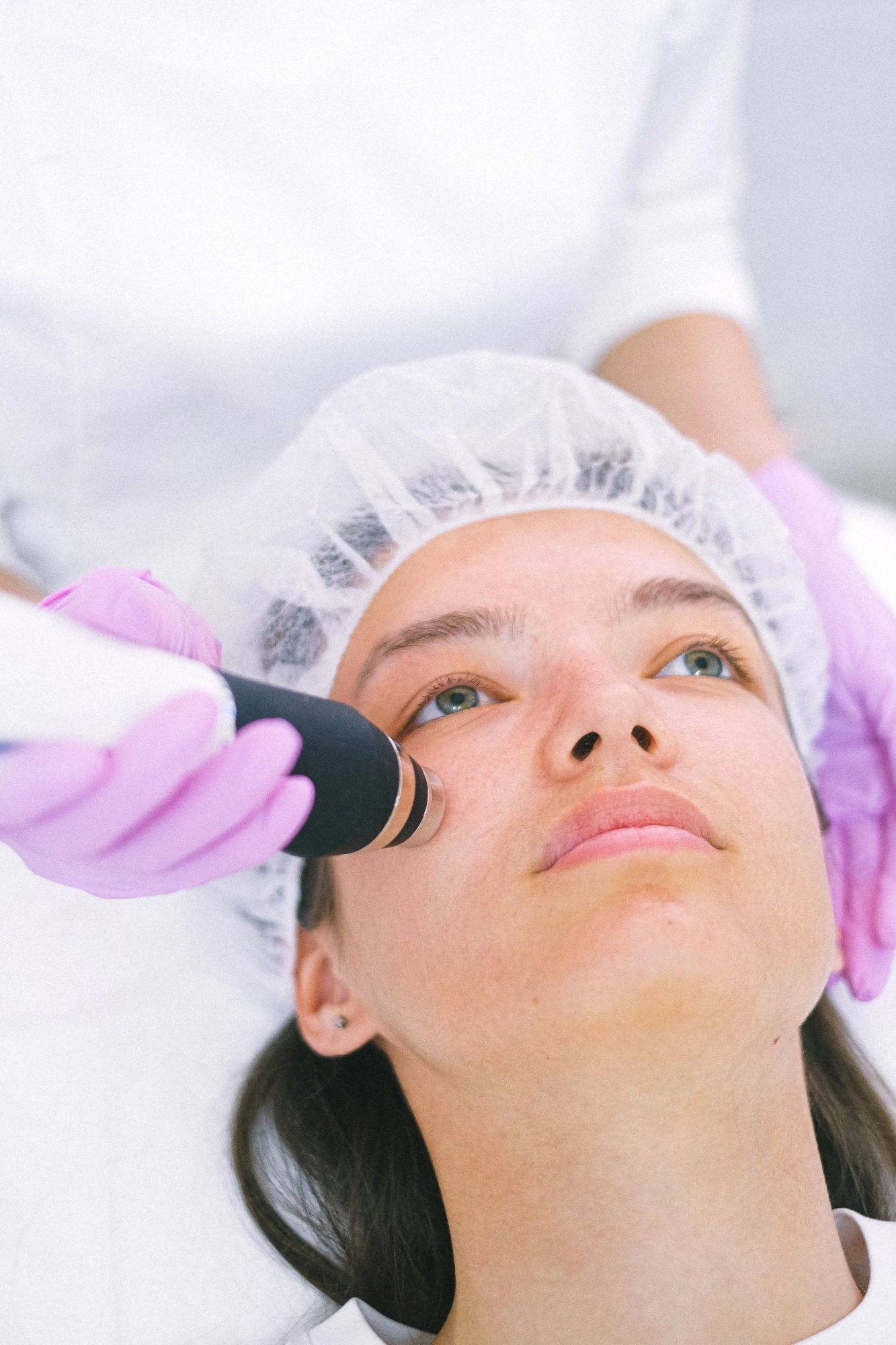 Acne scar treatments