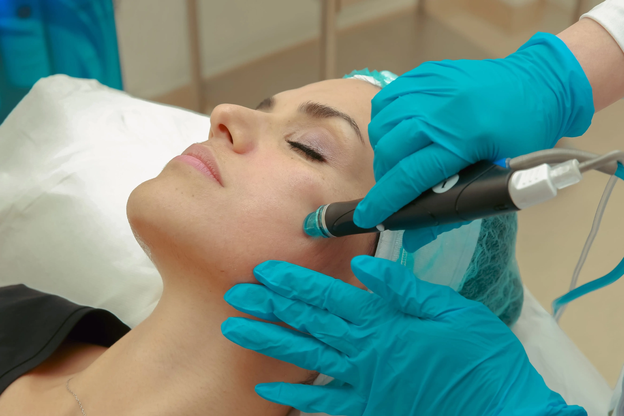 Microdermabrasion & Microneedling progress