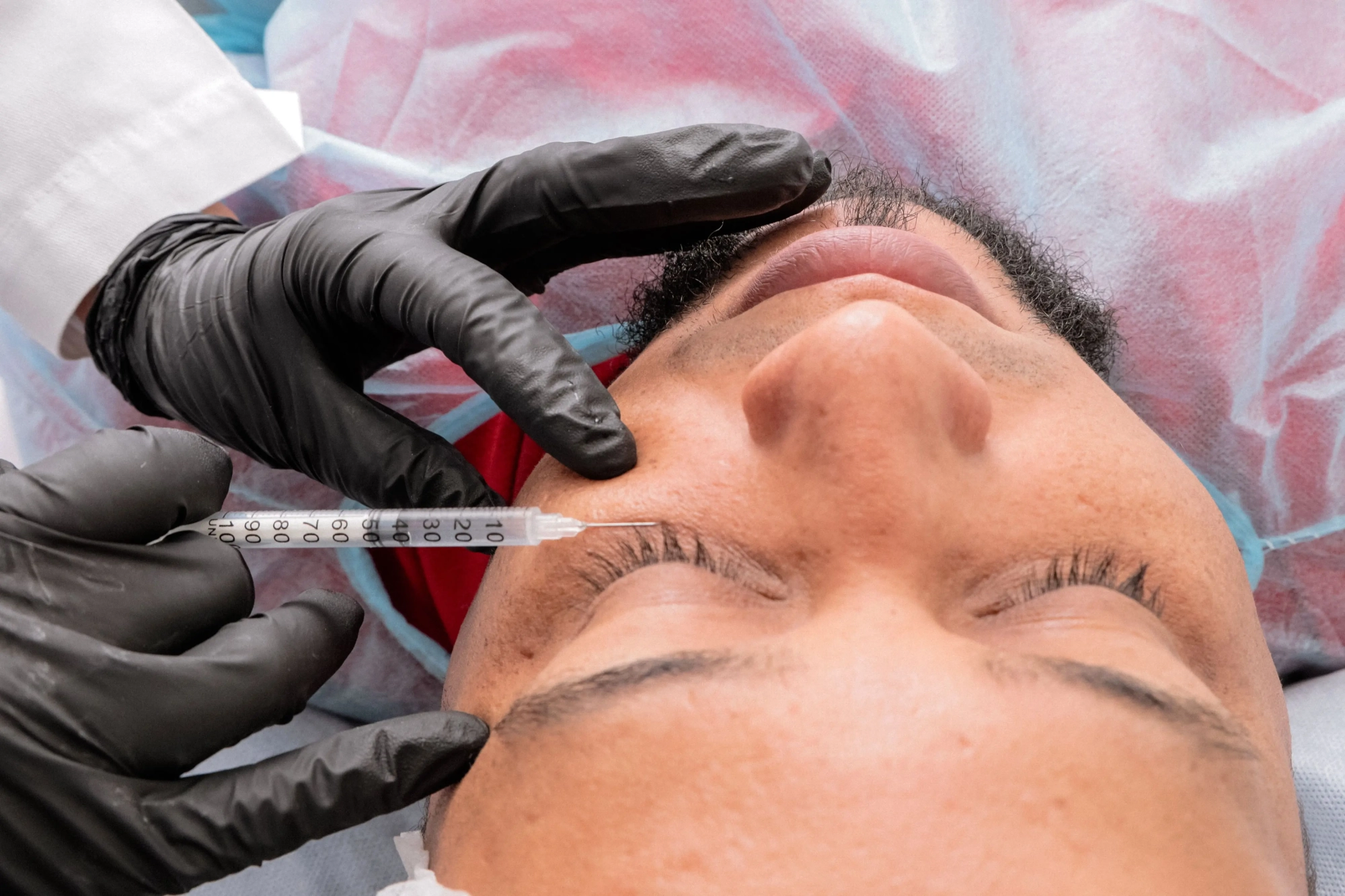 PRP Treatment in progress
