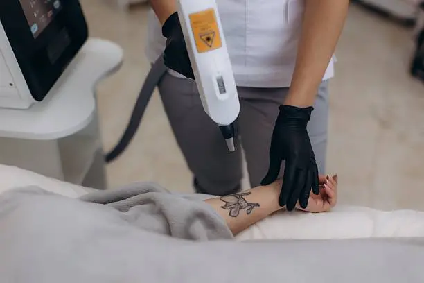 Tattoo Removal progress