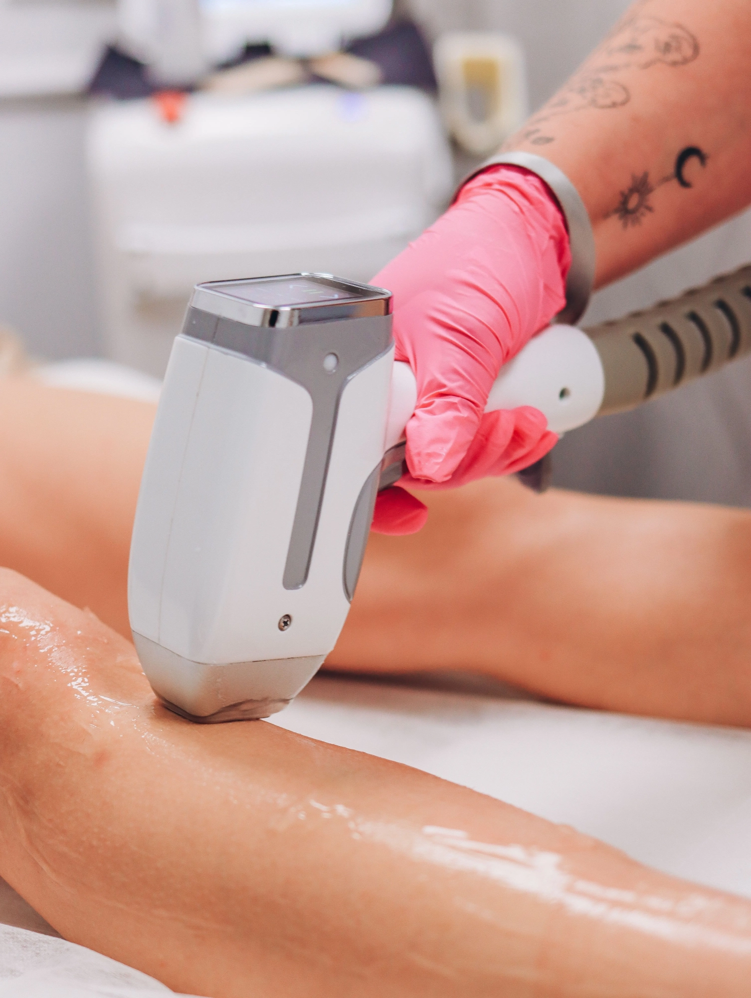 Tattoo Removal treatments